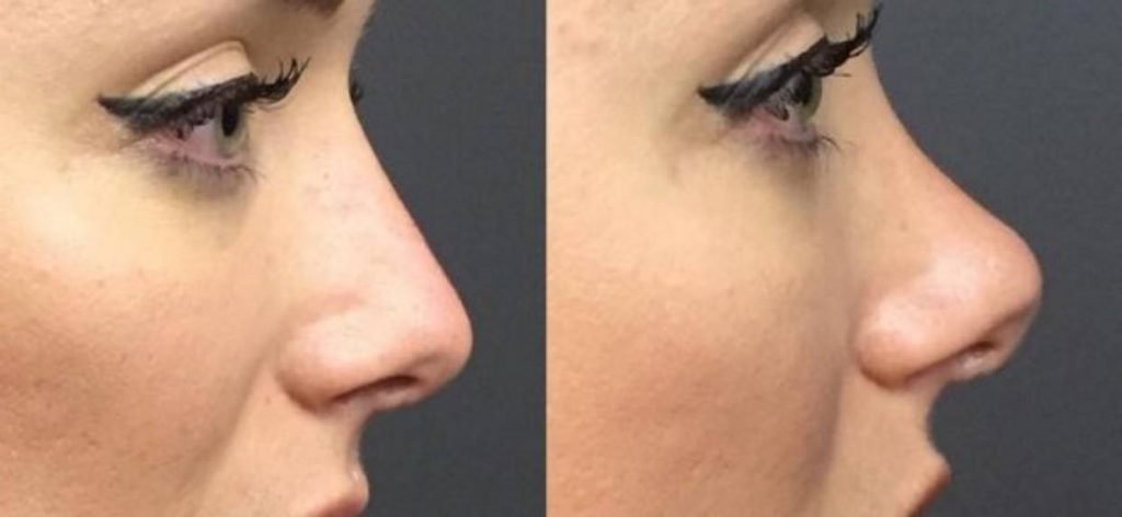 Nonsurgical rhinoplasty 3