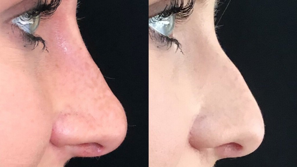 Nonsurgical rhinoplasty n