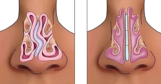 What is septorhinoplasty