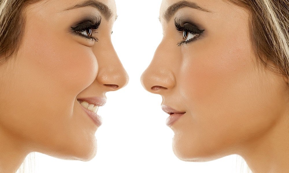 What is the cost of Rhinoplasty
