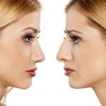 rhinoplasty