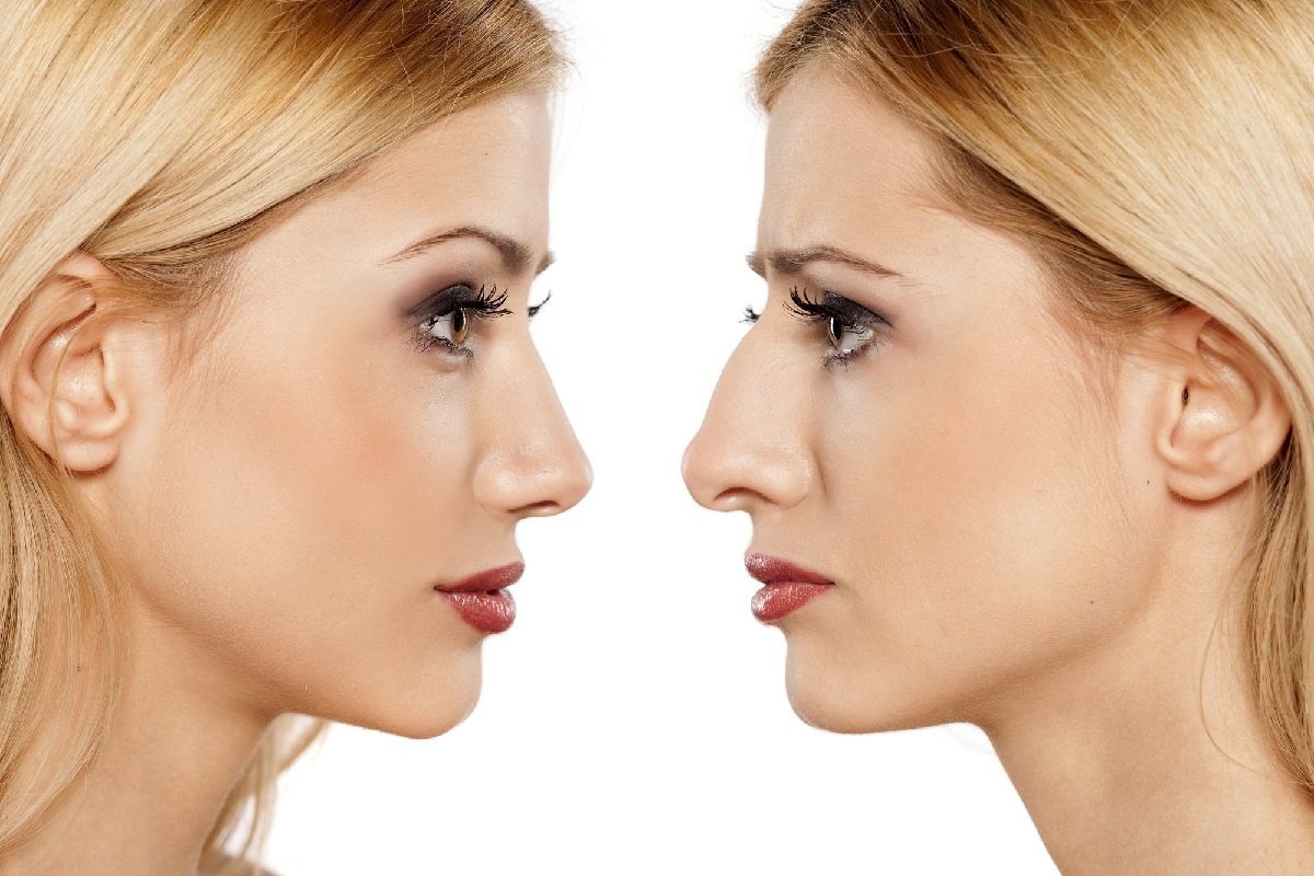 rhinoplasty